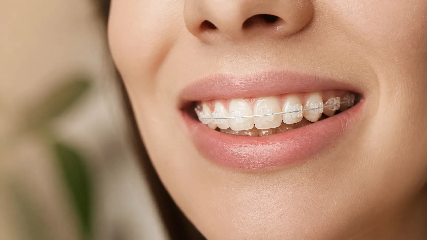 Aparat dentar ceramic discret la hiSmile Galați