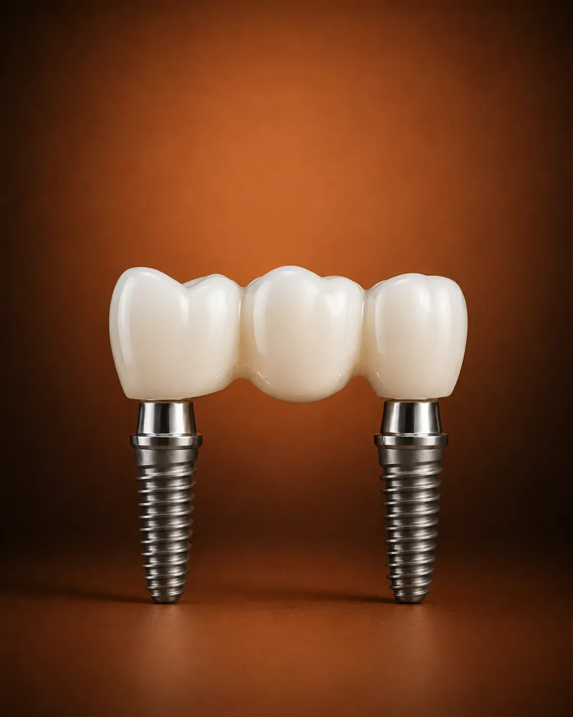 Comparație punte dentară vs implant - clinica hiSmile Galați